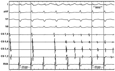 pontine infarction icd 10